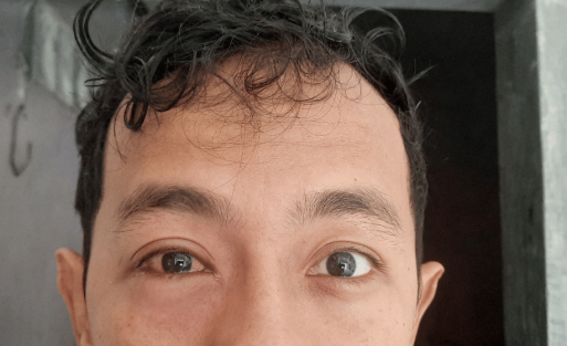 Cara Menyembuhkan Mata Bengkak